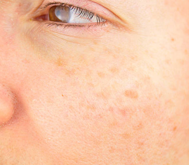 Natural Remedies to Treat Age Spots at Home 